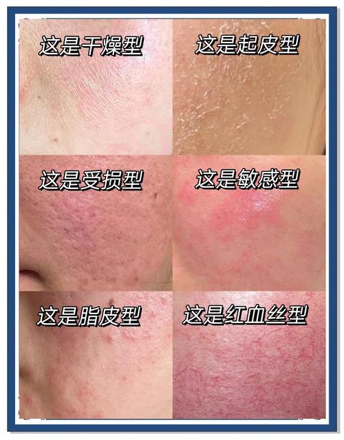 敏感肌错误使用美容仪导致皮肤屏障受损示例