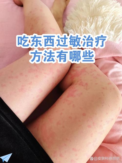 吃的东西,怎么突然就过敏了?