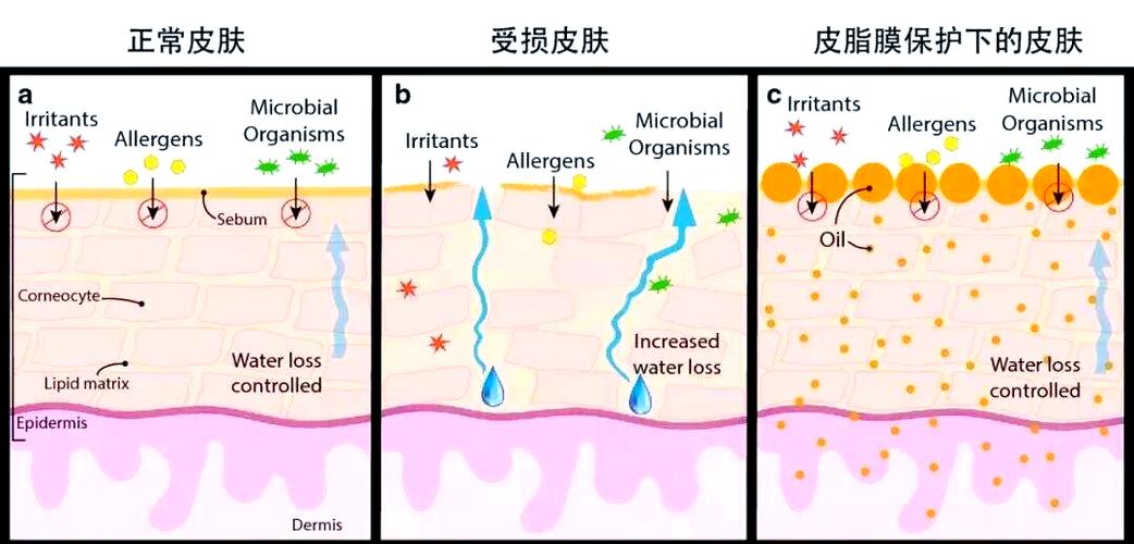 冬季热水澡破坏皮肤皮脂膜示意图