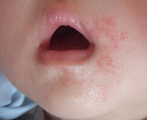 婴幼儿吃辅食后嘴边轻度刺激泛红实拍