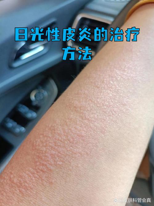 日光性皮炎不同场景SPF选择参考图