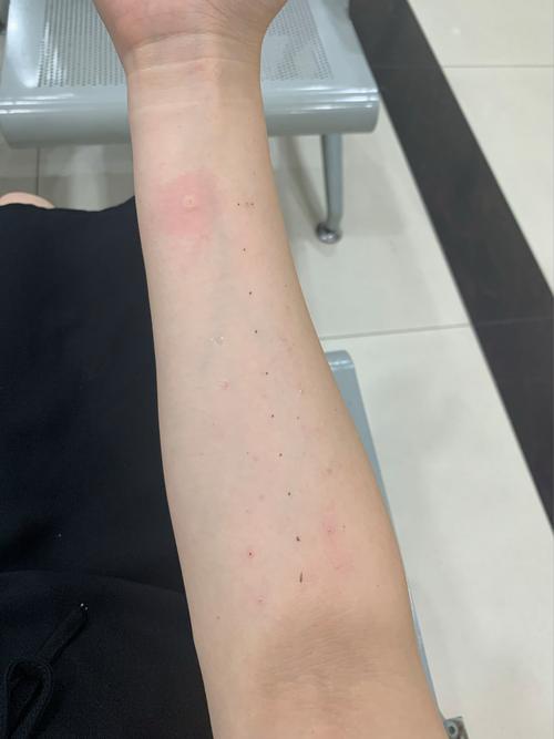 工厂员工过敏原检测皮肤点刺试验实拍