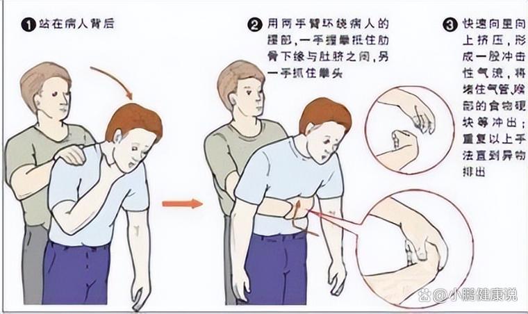 异物呛咳应对:那些你不知道的实用常识-仁者医