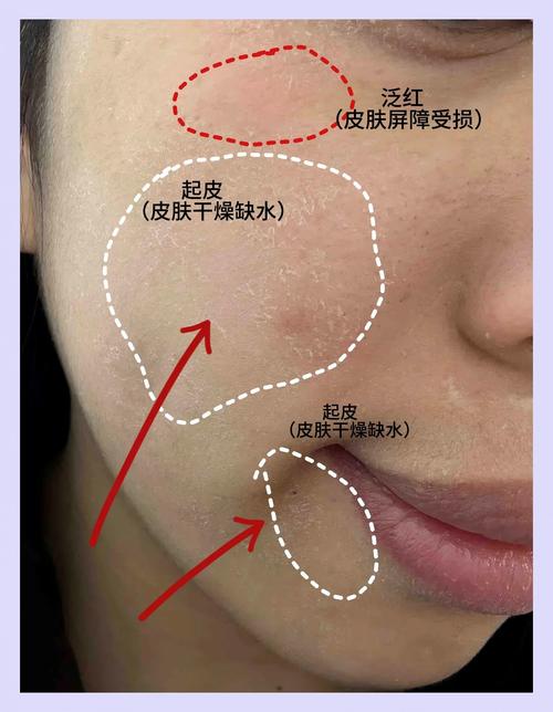 干燥季节皮肤容易脱屑的清洁与保湿步骤-仁者医