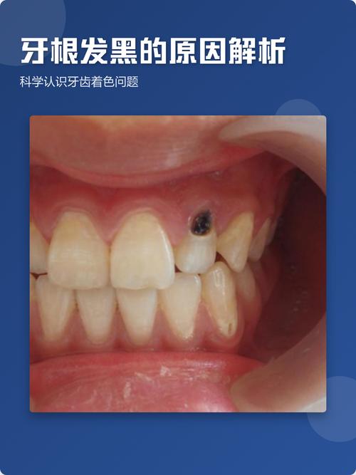 犬猫重度牙结石牙根发黑示意图