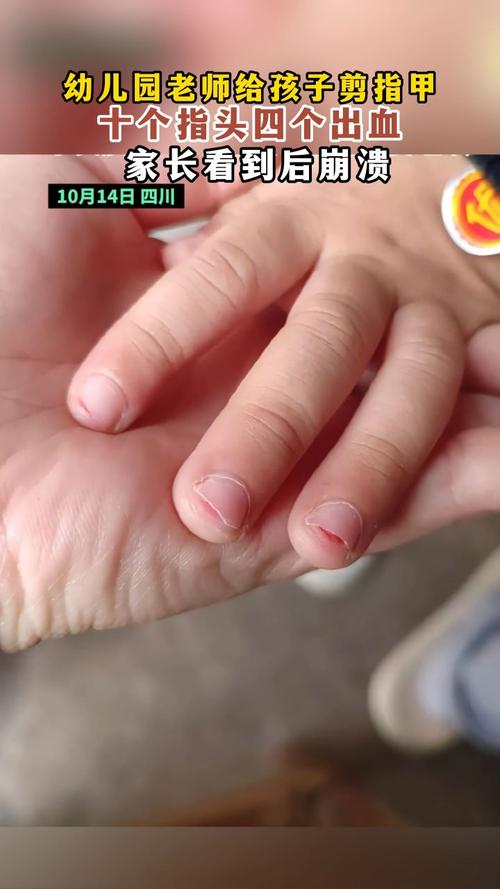 童年留下的剪指甲阴影