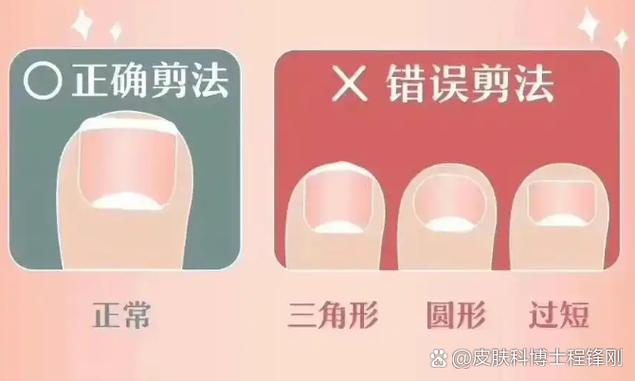 正确与错误指甲修剪对比图