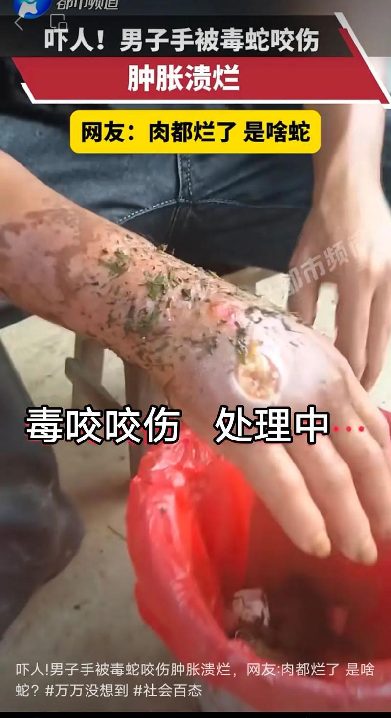 我的真实经历：被蟒蛇咬了一口