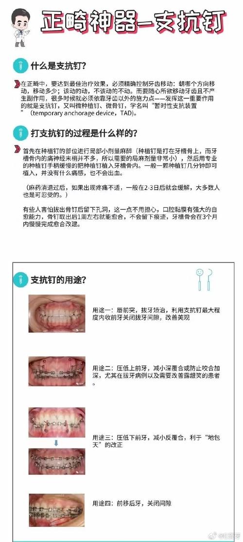 为什么要跟一颗锚栓较劲