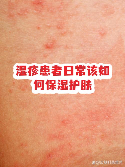 湿疹：保湿是胜利关键