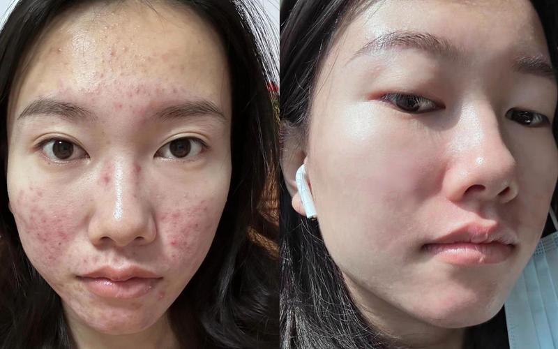产后爆痘敏感烂脸状态对比图