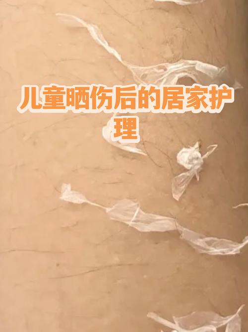 宝宝晒伤后的居家护理&就医红线