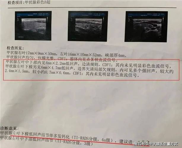 体检超声发现甲状腺结节报告单示意图