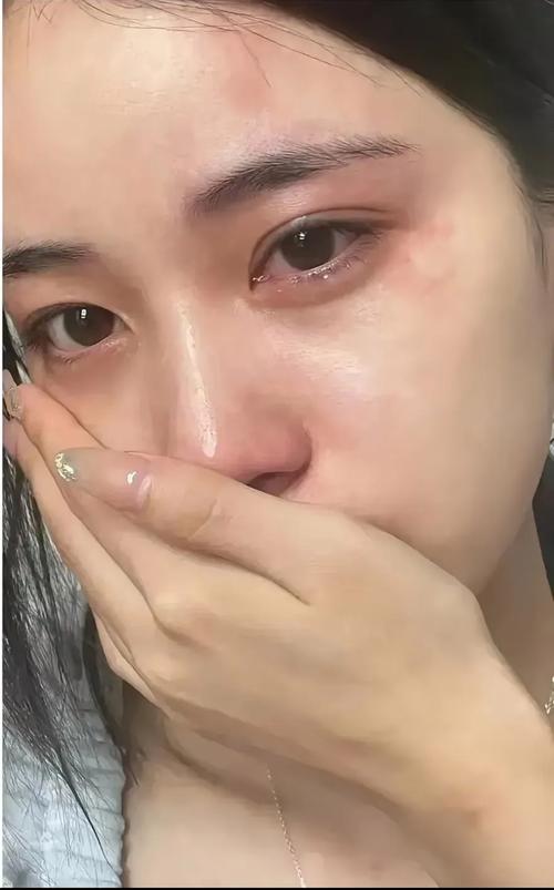 新娘婚前皮肤崩溃满脸闭口特写