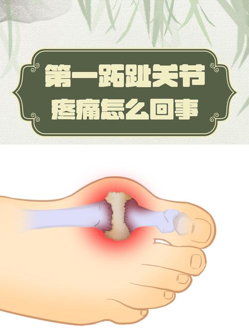 痛风急性发作第一跖趾关节红肿示意图