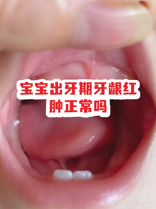 宝宝出牙不适牙龈红肿示意图