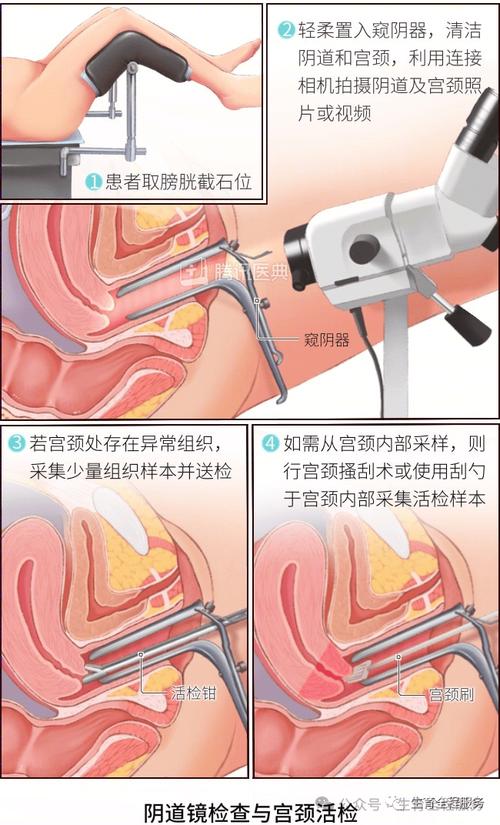 妇科门诊宫颈筛查取样操作示意图
