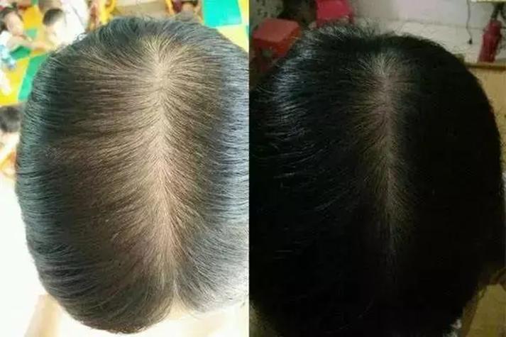 产后不同程度发缝宽度对比图
