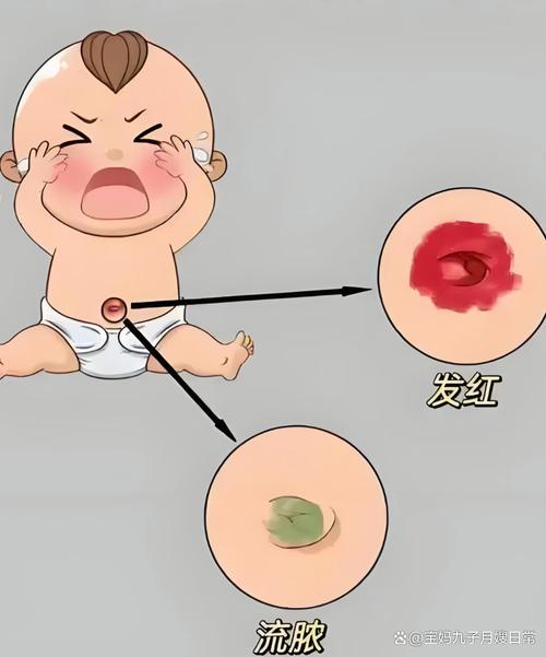 新生儿宝宝脐部感染危险症状对比图