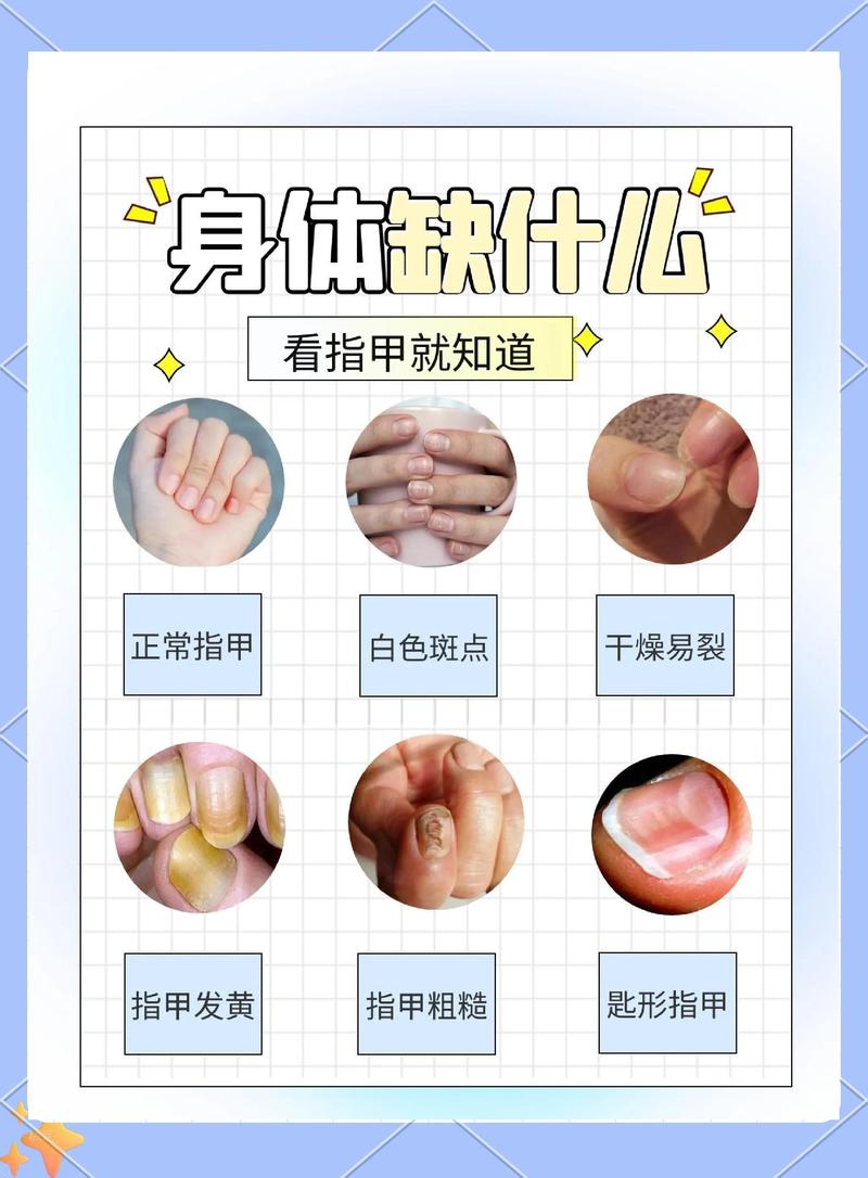 那些网传的指甲信号,到底哪些要当心