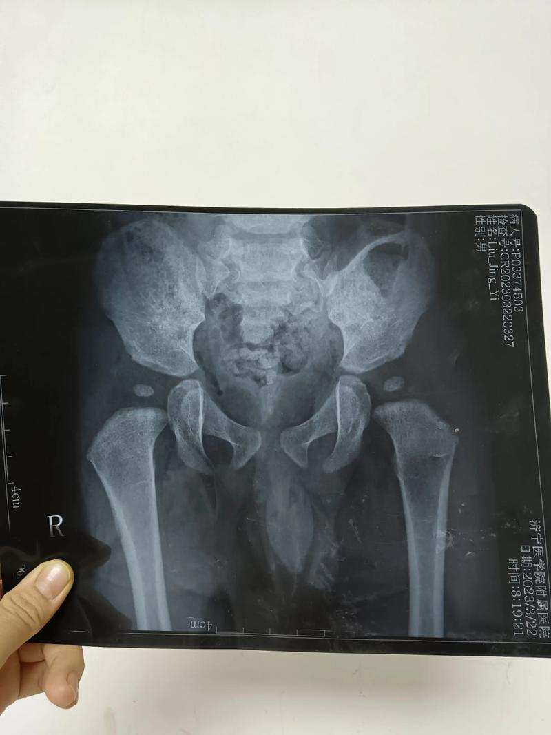 婴幼儿髋关节发育不良X光对比图