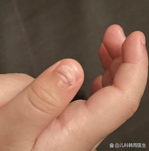 宝宝指甲修剪后哪些情况必须就医
