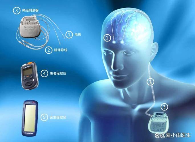 临床帕金森治疗脑深部电刺激设备示意图