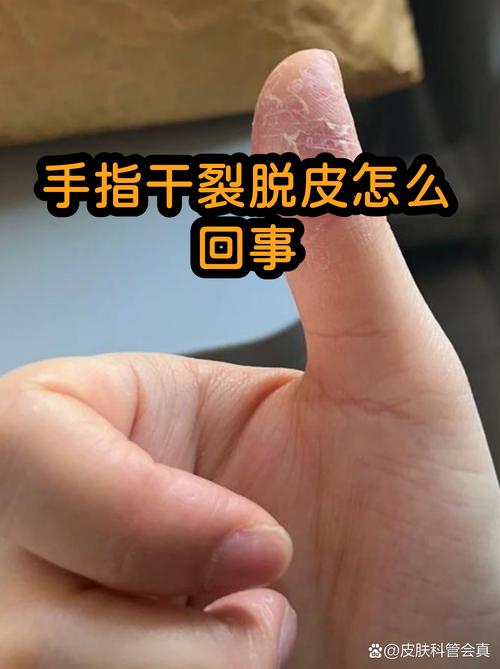 干到开裂脱皮，别硬扛