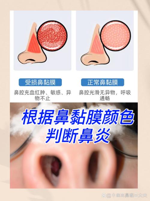 正常鼻腔与感冒后肿胀鼻腔对比示意图