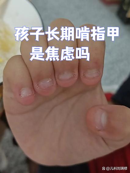 六岁儿童咬指甲焦虑表现示意图
