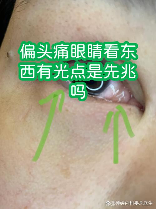 偏头痛视觉先兆闪光暗点示意图