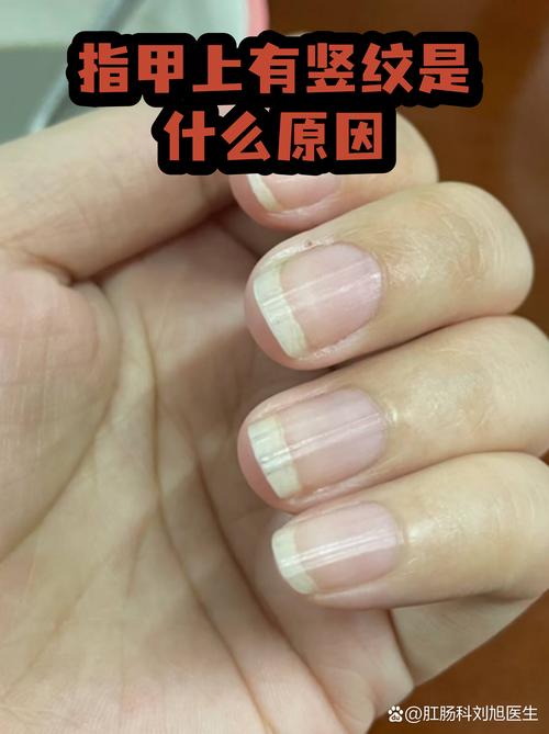 指甲良性竖纹实拍参考图