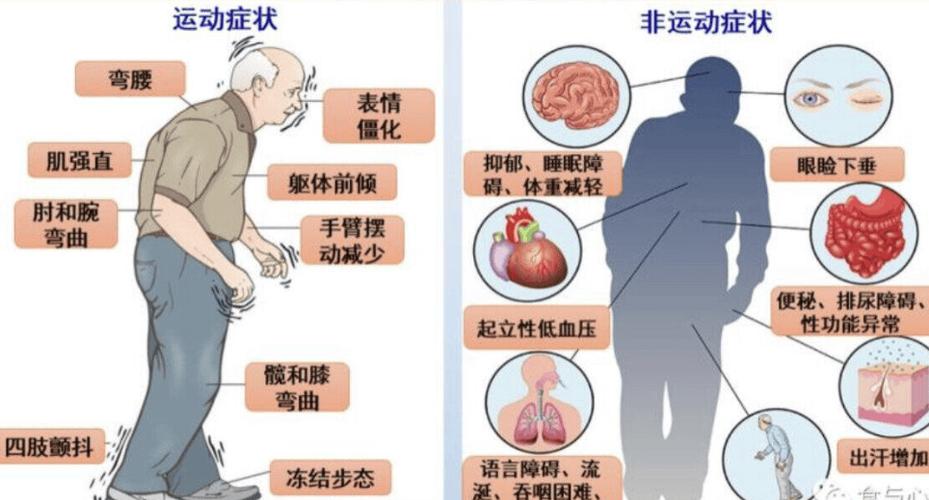 帕金森病异常步态对比示意图