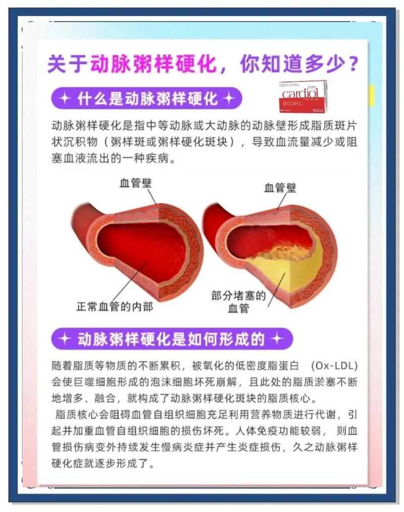健康血管与动脉硬化对比示意图
