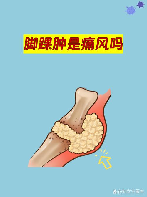 痛风发作肿胀的踝关节示意图