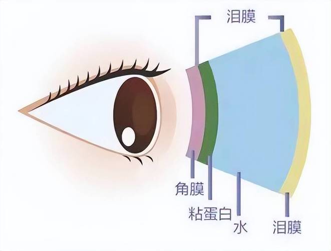 干眼症正常泪膜对比破裂示意图