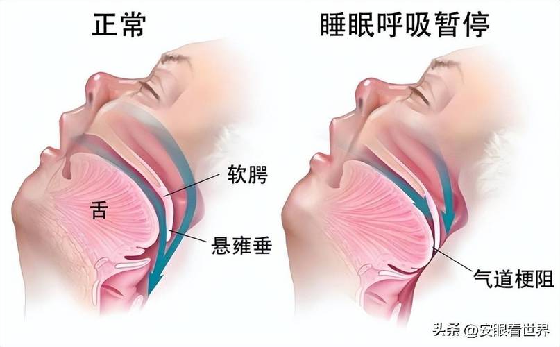 睡眠呼吸通畅与打鼾时气道状态对比图