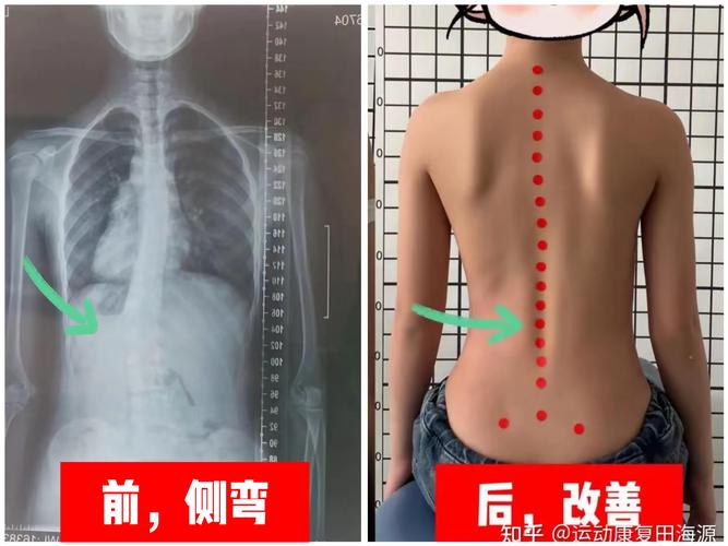 正常后背与脊柱侧弯后背镜面对比图