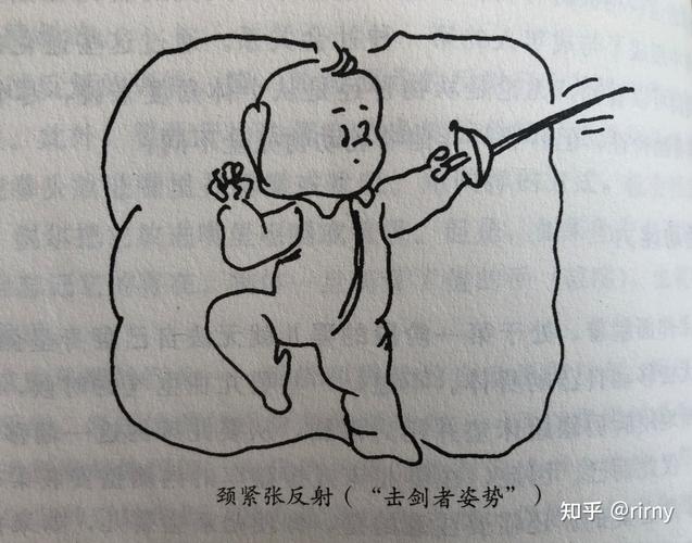 婴儿强直性颈反射击剑姿势演示图