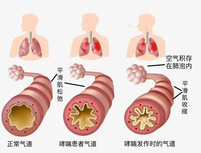 换季哮喘患者气道受刺激变化示意图