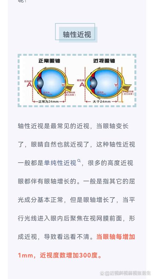 眼轴增长与近视成因医学示意图