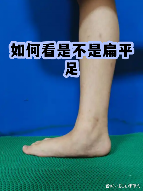 宝宝站立足弓异常判断示意图