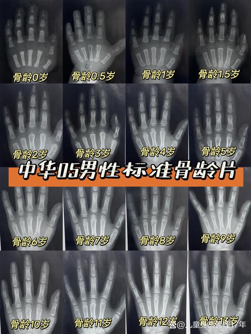 儿童青春期前兆骨龄对比读片图