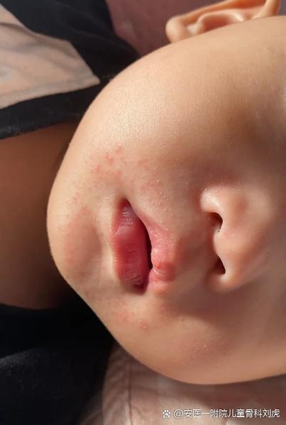 6月龄宝宝辅食过敏嘴角红点实拍
