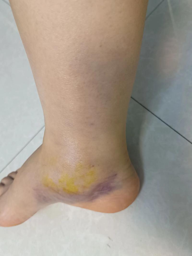 受伤了咋整?还能继续跳吗?