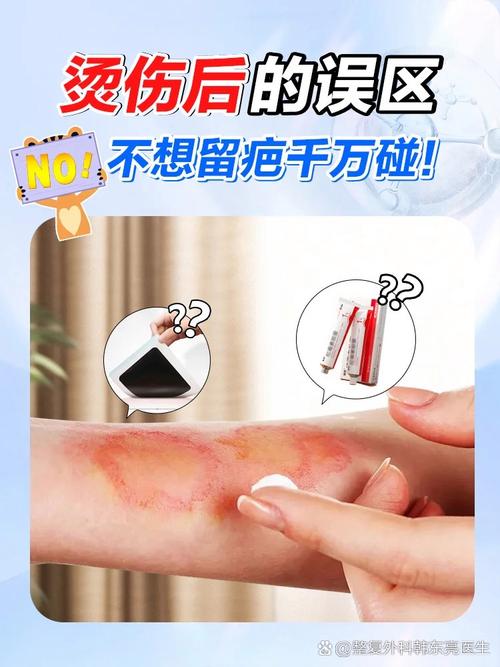 常见错误烫伤处置误区汇总图