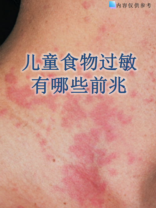 婴幼儿食物过敏初期红疹实拍