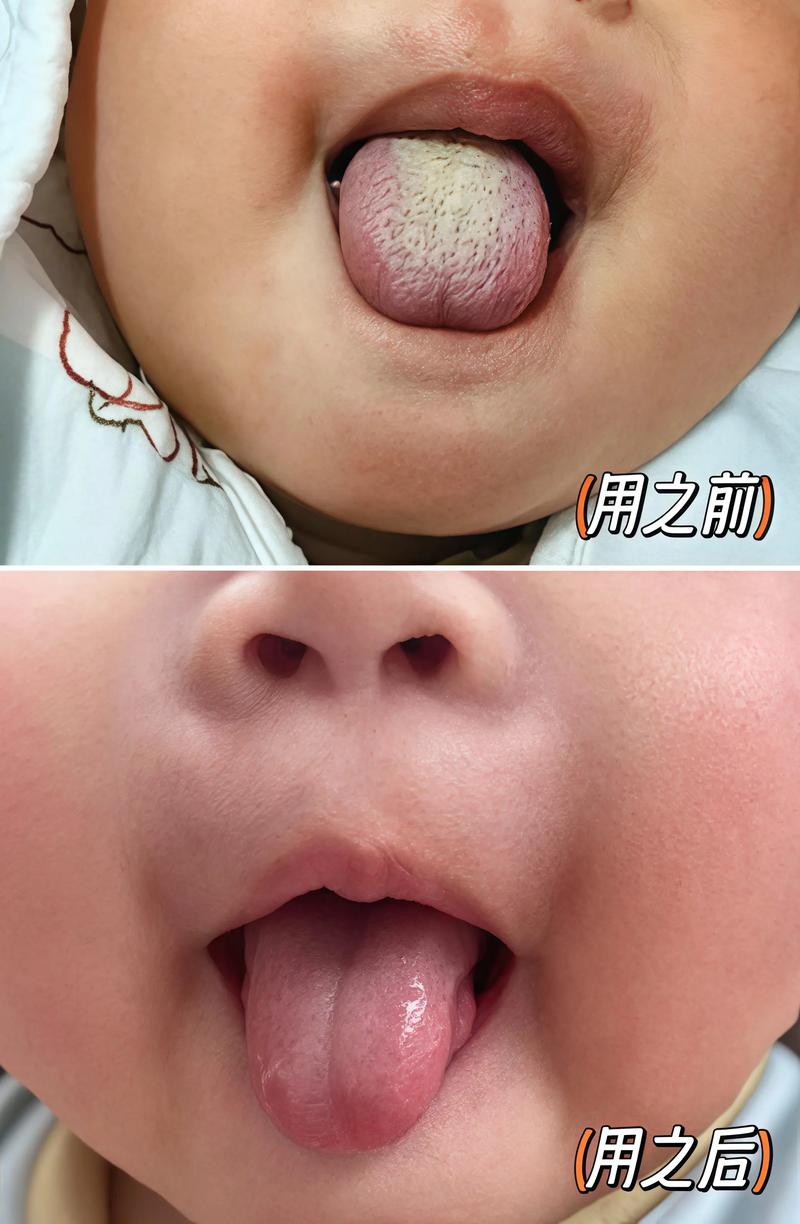 儿童积食舌苔厚腻照片