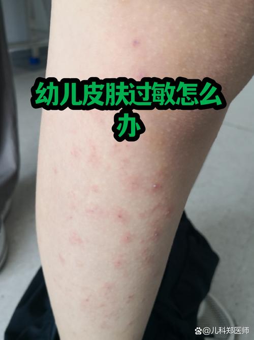 过敏宝宝的家庭环境调整