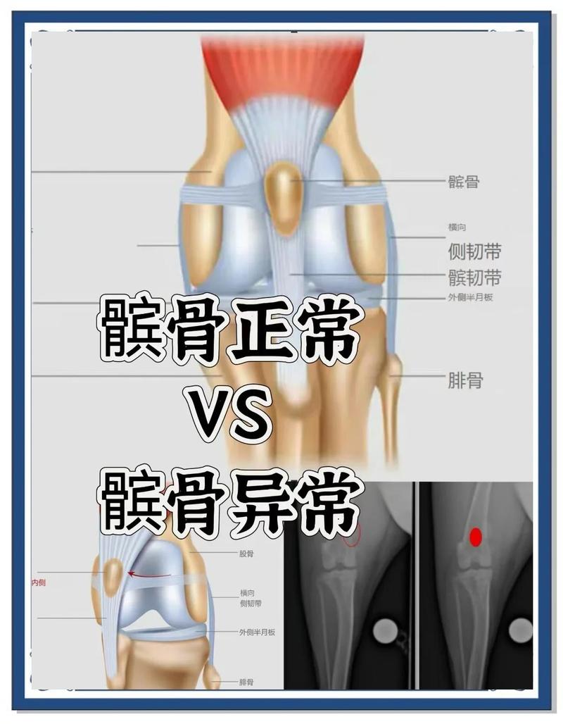 猫髌骨脱位四级分级对照解剖示意图